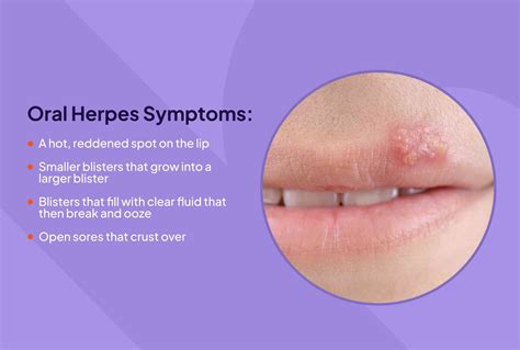 disorder hermes|what causes herpes in adults.